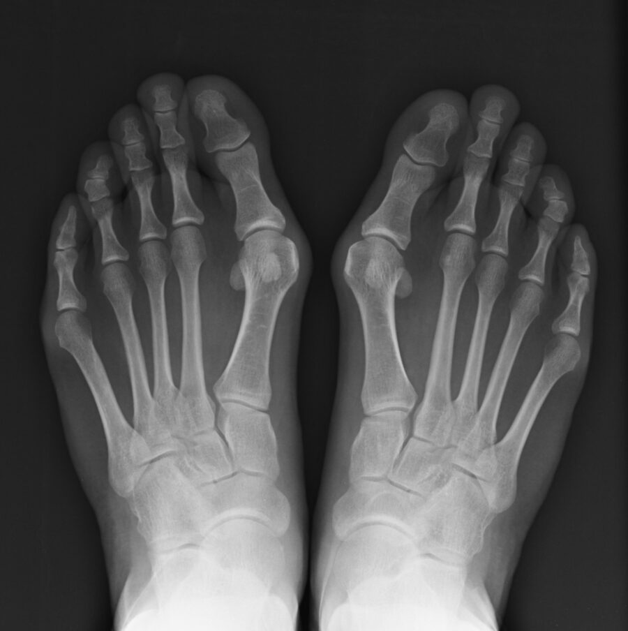 ALLUCE VALGO vergiate varese