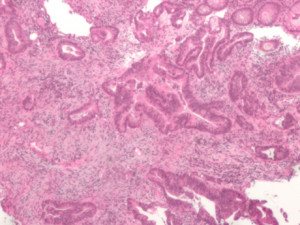 carcinoma del retto - vergiate varese