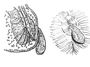Condilomi anali dr. tessera