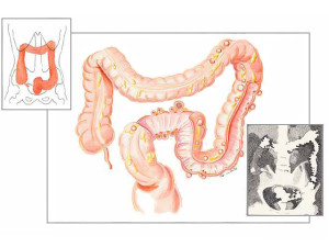 diverticoli-colon-dr.tessera