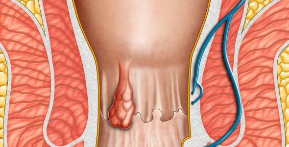 emorroidi pubblicazione_tessera