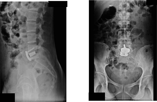 cura dolore lombare vergiate varese