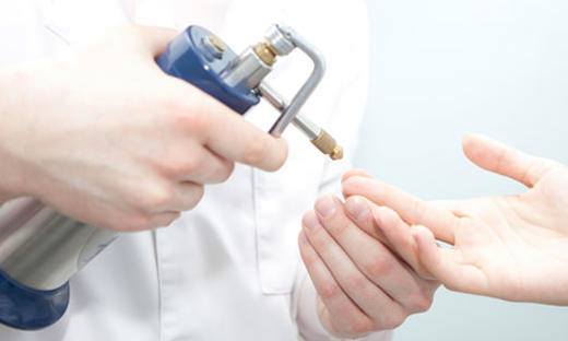 crioterapia verruche vergiate varese