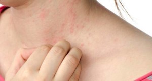 psoriasi vergiate varese