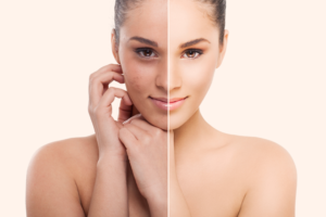 peeling acido salicidico