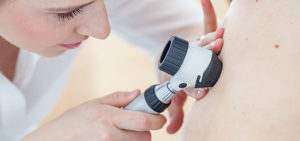 prevenzione del melanoma vergiate varese
