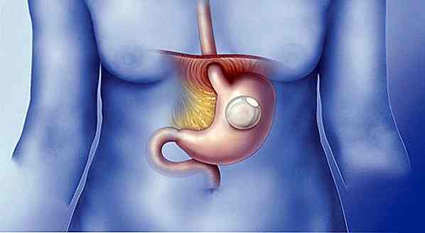 Palloncino Intragastrico