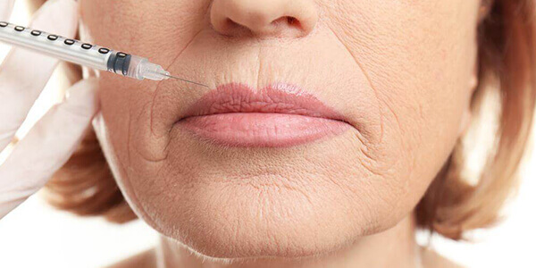 rughe contorno labbra centro san martino vergiate varese