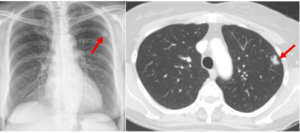 Tumore polmonare Centro San Martino vergiate varese