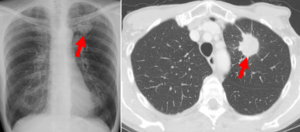 Tumore polmonare 2 Centro San Martino vergiate varese