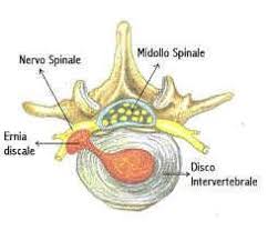 Ernia del Disco