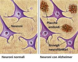 Neuroni normali e Neuroni con Alzheimer